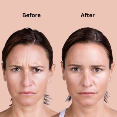 Buy Xeomin Online 2 Buy Xeomin Online Clear Unwanted Wrinkles