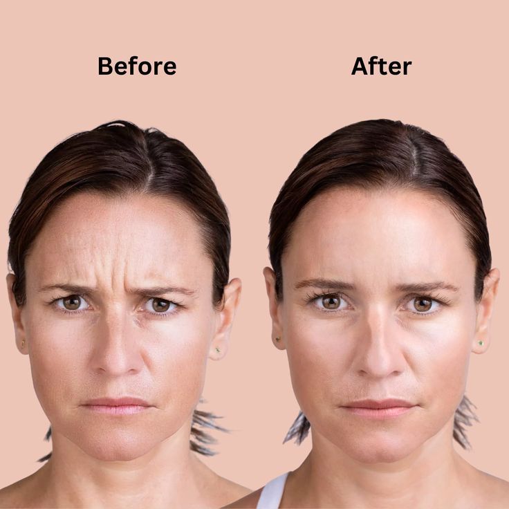Buy Xeomin Online Clear Unwanted Wrinkles