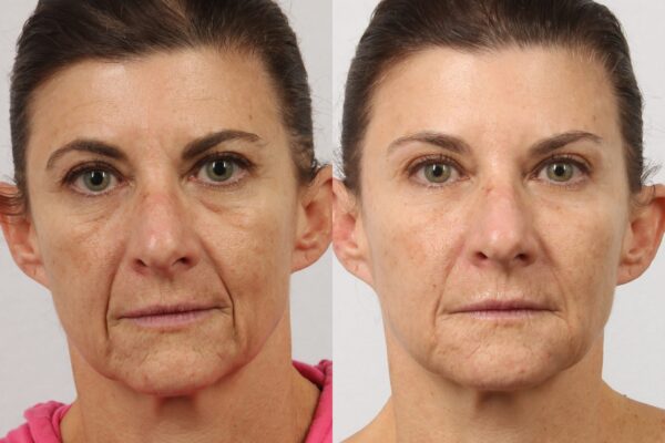 Buy Xeomin Online 3 Buy Xeomin Online